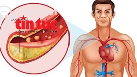 "Bác sĩ ơi' - Kiểm soát Cholesterol máu thế nào là đúng?